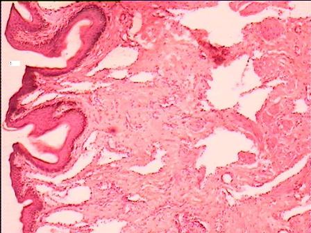 Figure 2. Microphotograph of fibroangioma scrotum.